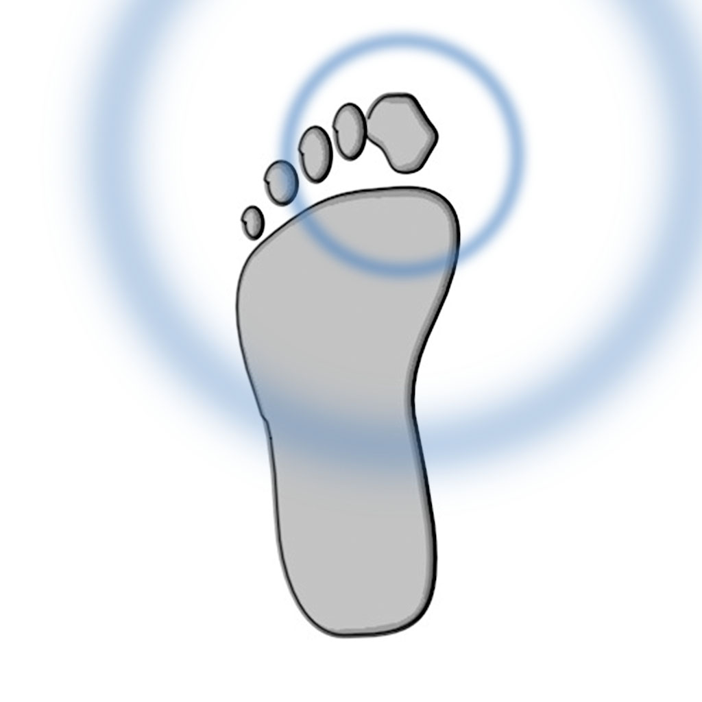 illustrazione alluce valgo